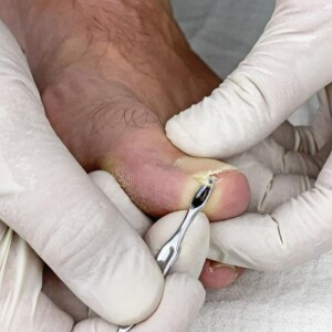 First Stage Ingrown Diabetic Toenails: Treatment & Safe Cutting Techniques