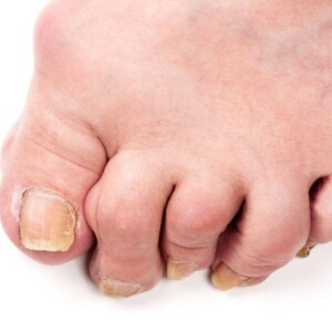 How to Get Rid of Bunions Naturally: Causes and Remedies