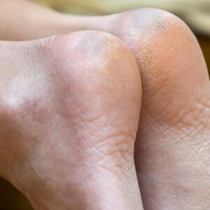 How to Remove Calluses From Feet and Get Rid of Them Permanently