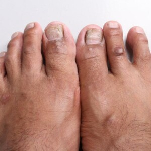 Early Stage Diabetes: Recognizing Foot Signs, Symptoms, and Issues