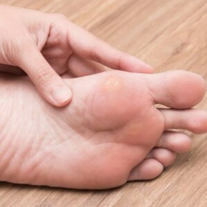 Discovering What Causes and How to Get Rid of Painful Corns on Feet