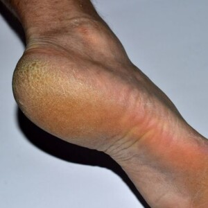 Finding What Causes a Heel Spur and What Do Heel Spurs Feel Like?