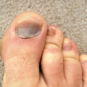 Hammer Toe Vs Claw Toe: Discovering Their Key Differences