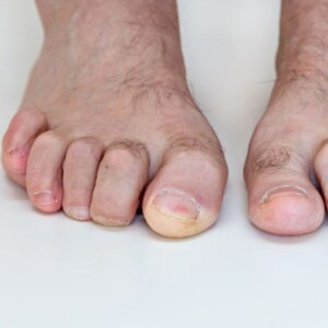 What Is Mallet Toe Deformity and Its Causes?