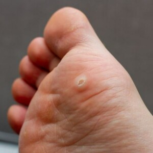 What Is and What Causes Viral Plantar Warts on Toes & Feet?
