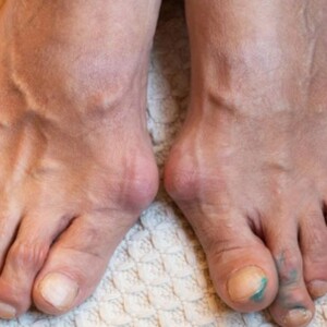 Do Not Let Big & Pinky Toe Dislocations Go Untreated | Fix at Home – Learn safe at-home methods to fix a dislocated toe and when to seek medical help.
