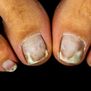 Onychogryphosis (Ram’s Horn Toenail) | Definition & Treatment – Learn the Causes, Symptoms, and Best Treatment Options for This Thickened, Curved Nail Condition