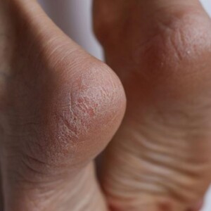 How Diabetes Affects Foot Numbness & Tingling | Causes & Prevention – Learn How Diabetes Leads to Nerve Damage, Causing Foot Numbness and Tingling, and What You Can Do to Prevent It