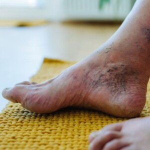 What Does a Stress Fracture Feel Like? | Signs & Symptoms in Foot – Learn How to Recognize Stress Fracture Pain, Early Warning Signs, and When to Seek Treatment