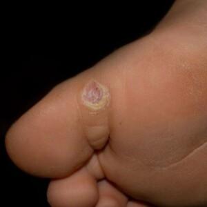 Stages of Plantar Wart Healing & Falling Off After Freezing | Pictures – See What to Expect After Cryotherapy with Images of the Healing Process