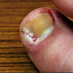 Types of Toenail Diseases & Infections | Examples, Pictures & Treatment – Discover common toenail conditions, their symptoms, and the best treatments with visual examples.