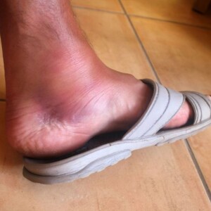 What Causes Gout Disease? | Reasons for How You Get Gout in Feet – Learn what triggers gout, why it develops in the feet, and how to prevent painful flare-ups.
