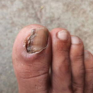 How to Fix Ingrown Toenails Permanently at Home | Best Remedies – Discover proven home treatments to fix ingrown toenails permanently and prevent future pain.