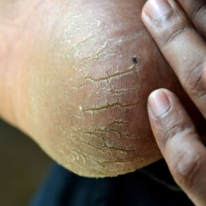 Different Types of Foot Fungus | Treatment, Pictures & Images – Learn how to identify and treat common foot fungus infections with helpful pictures and expert tips.