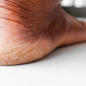 What Fungus Pathogen Causes Athlete’s Foot? | Early Stage Signs – Learn which fungus triggers athlete’s foot, how it starts, and the first symptoms to watch for.