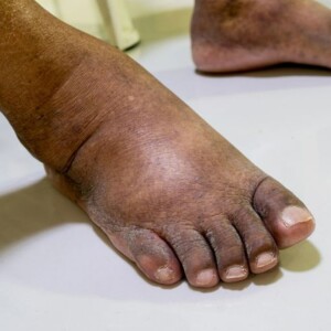 What is The Difference Between Sesamoiditis Vs Gout: How To Know Its Causes According to Foot and Ankle Experts