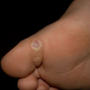 How to Get Rid of a Plantar Wart Quickly and Naturally at Home Using Safe Remedies Backed by Experts at The Releford Foot and Ankle Institute