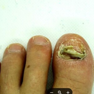 What’s the Difference Between Toenail Mold vs Fungus? Learn How to Spot the Subtle Signs and Treat Each Condition With Confidence and Care
