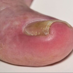 Swollen Infected Toe? Discover the Signs and Causes of Bacterial and Fungal Ingrown Toenail Infections and How to Treat Them Effectively