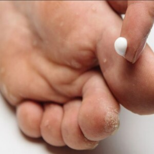 How to Treat Vesicular Athlete’s Foot Infection and Blisters on Feet: Expert Advice for Relieving Pain, Stopping the Spread, and Healing Fast at Home