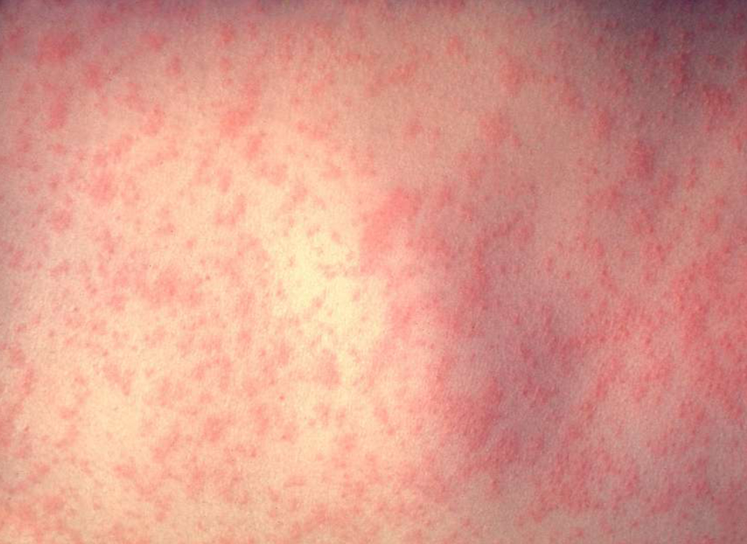 Why We Vaccinate Against Measles