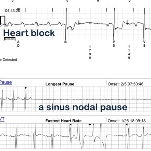 Bradycardia: When does a Slow Heart Rate Becomes a Health Concern?