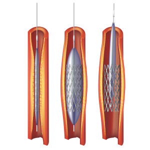 10 Things Everyone Who Has Had a Coronary Stent or Bypass Operation Should Know