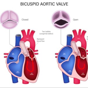 Aortic Stenosis