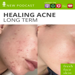 Healing Acne, long term