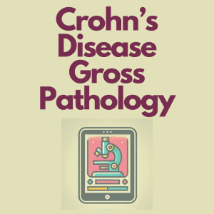 Crohn's Disease: A Subtotal Colectomy Case Study