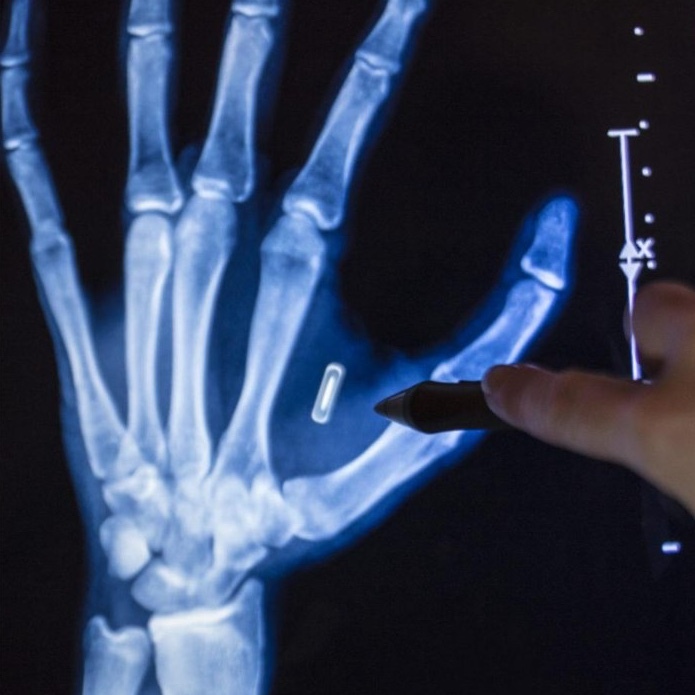 The Invisible Crime: Illegal Microchip Implants and Microwave Technology