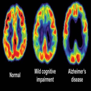 Prescribed Dementia