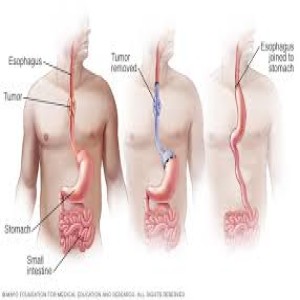 The Different Facts to Know More about Esophagus Cancer