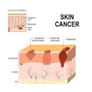 Alert- Colorado Spring Skin Cancer- What to look for