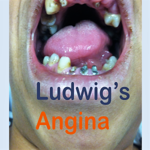 Ludwig's Angina- more than a toothache