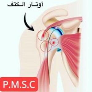 علاج التهاب اللفافة الأخمصية بالليزر في الأردن