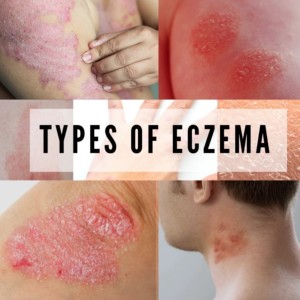 Eczema: Epigenetics, Symptoms, & Treatment