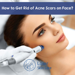 Acne scar treatment in Dubai