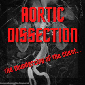 Aortic Dissection- The thunderclap of the chest