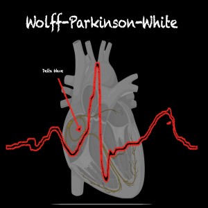 Wolff-Parkinson-White