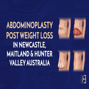 Abdominoplasty After Weight Loss: What You Need to Know