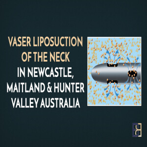 VASER Liposuction for the Neck with Dr. Beldholm | Everything You Need to Know
