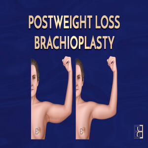 Post Weight Loss Arm Lift (Brachioplasty) Operation Explained