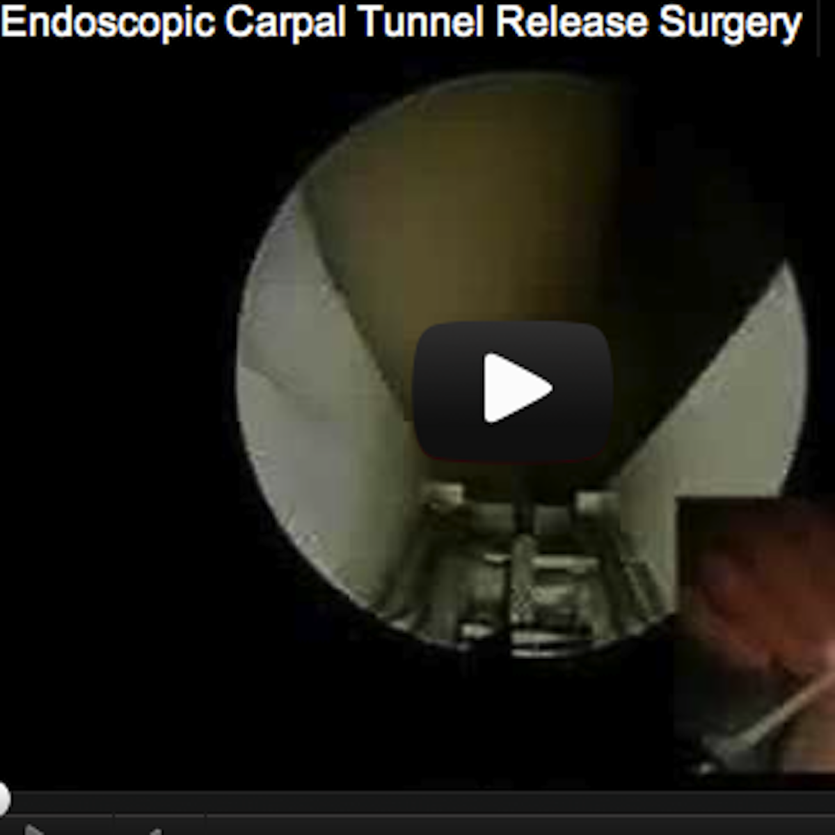 Endoscopic Carpal Tunnel Surgery Dr. Wint narrates