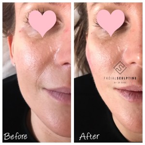 Recommended Botox Clinics London|facialsculpting.co.uk|Call 07340093939