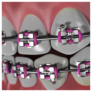 Candidate For Dental Braces Treatment – Norwalk and Long Beach CA