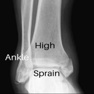 High Ankle Sprain Episode 1
