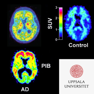 #89 Ny behandling mot Alzheimers sjukdom