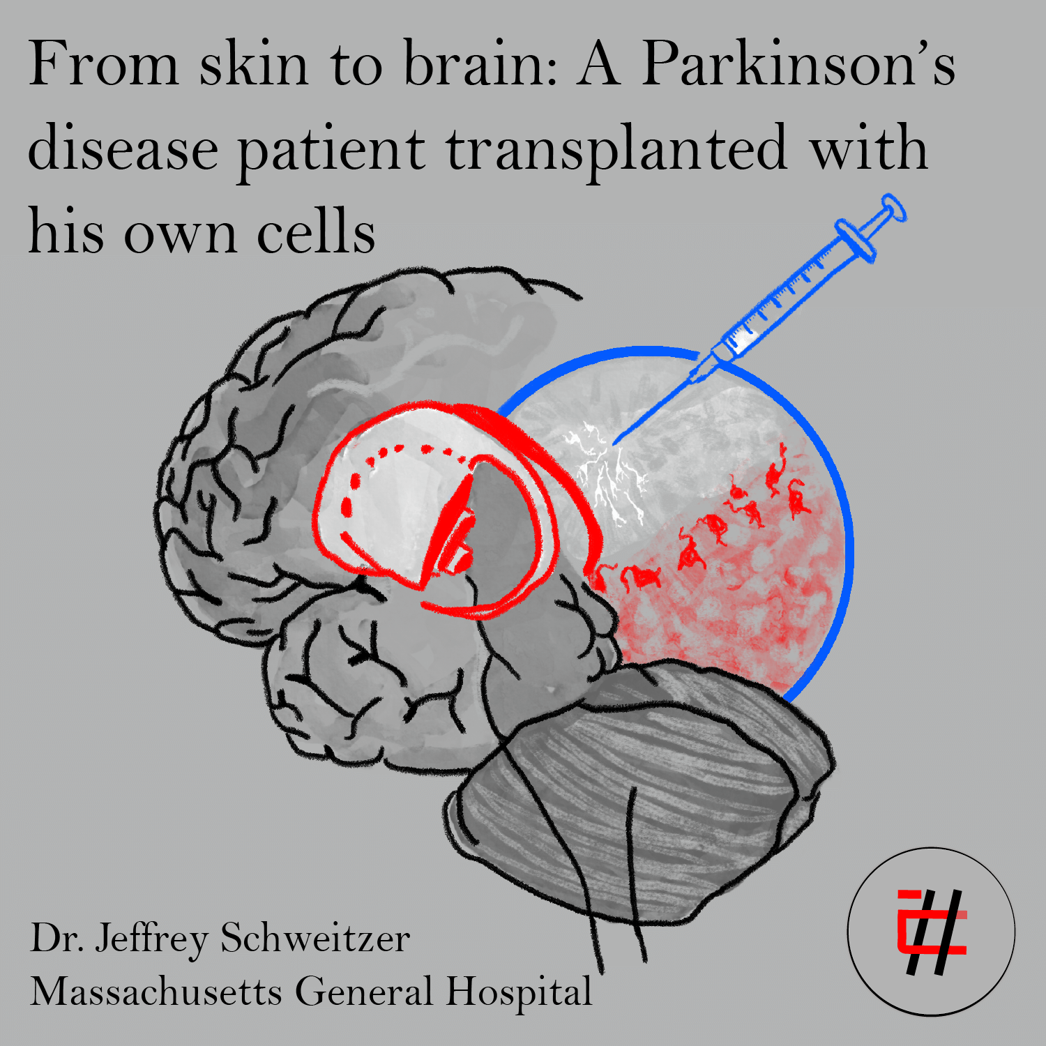 From Skin to Brain: A Parkinson’s Disease Patient Transplanted with His Own Cells