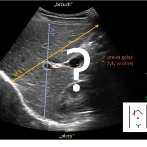 Jak mierzyć wątrobę w badaniu ultrasonograficznym?